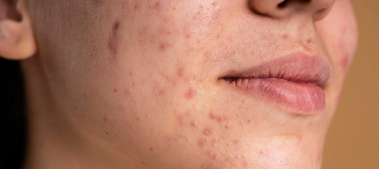 تاثیر مصرف شیرینی بر سلامتی و بدن 3 تصویری درباره تاثیر مصرف شیرینی بر پوست
