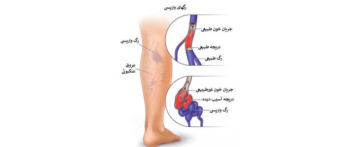 واریس پا چیست؟ بررسی علل، علائم + درمان 1 علائم و عوارض واریس پا