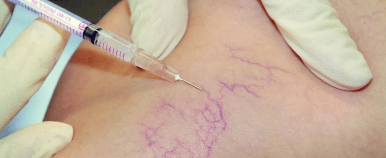 واریس پا چیست؟ بررسی علل، علائم + درمان 3 روش های درمان واریس پا