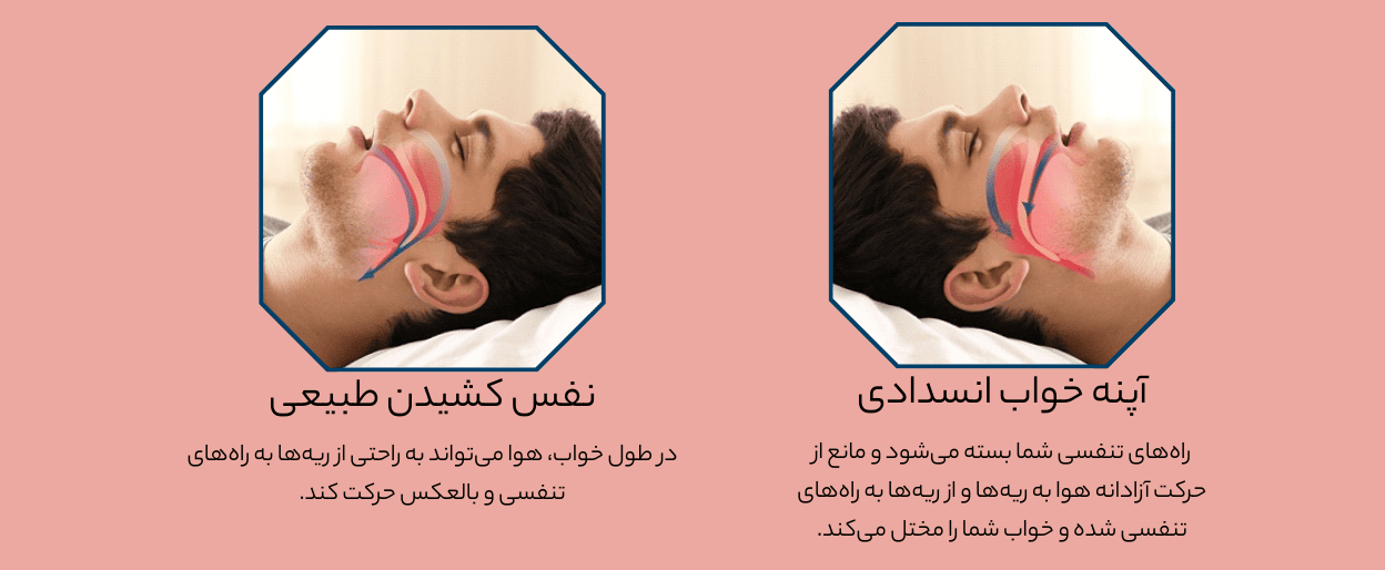 دستگاه سی پپ (CPAP) چیست؟ + عوارض و فواید آن برای بهبود کیفیت خواب 1 آپنه چیست ؟