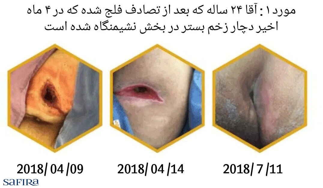 نتایج به دست آمده از درمان توسط پماد مدی هانی 405