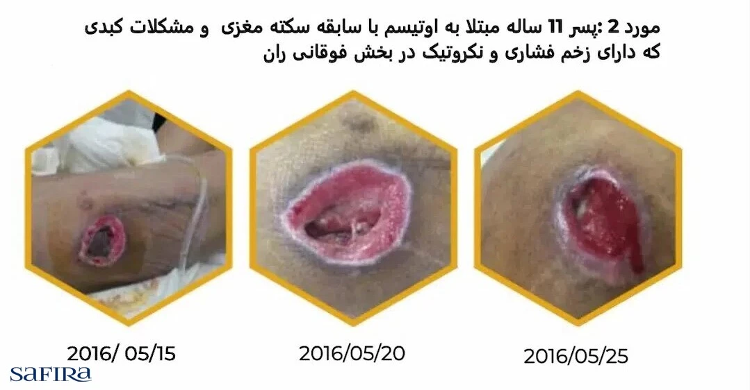 نتایج به دست آمده از درمان زخم فشاری توسط پماد مدی هانی 405