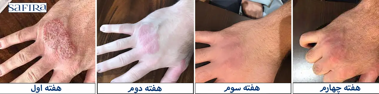 قبل و بعد از درمان توسط کرم ترمیم کننده سیکالفیت اون